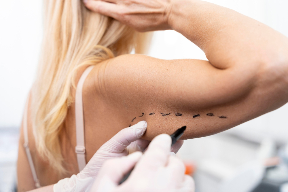 Arm lift (Brachioplasty)